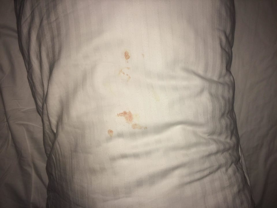 Blut aus dem Ohr wegen Poolwasser Kirman Belazur Resort & Spa