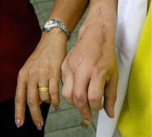 verheilter Kobrabiss