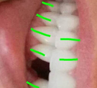Nha Khoa Xinh Dental terrible crowns