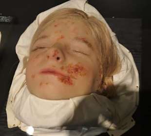 Wachsmodelle von Hautkrankheiten - die Moulagen