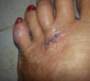 Infektion und geschwollen.