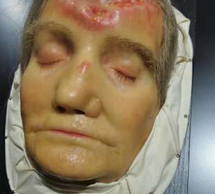 Wachsmodelle von Hautkrankheiten - die Moulagen