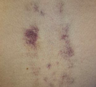 Blaue Flecken, nach der Massage