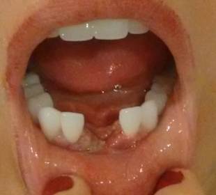 Gum infection and 2 implants badly placed by Nha K